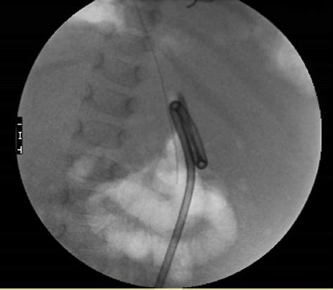 pegogram|Radiologic Percutaneous Gastrostomy: Review of Potential。